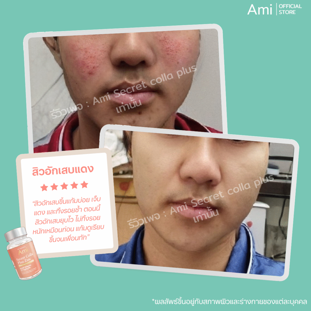 Ami Skin Supplement อาหารเสริมเพื่อผิวสวย ลดสิว รอยสิว บำรุงผิวใสสุขภาพดี