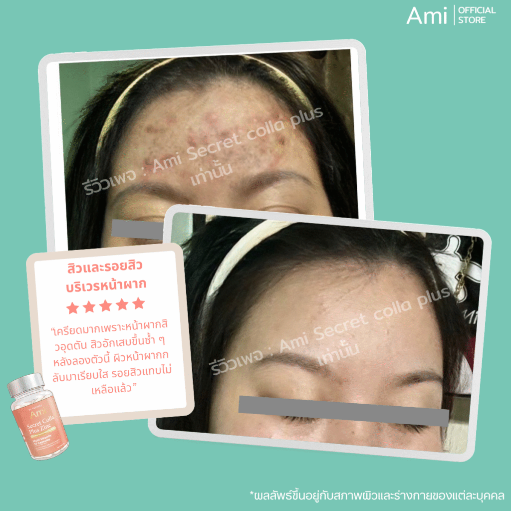 Ami Colla Zinc ลดรอยสิว อาหารเสริมเพื่อผิวสวย ลดสิว รอยสิว บำรุงผิวใสสุขภาพดี