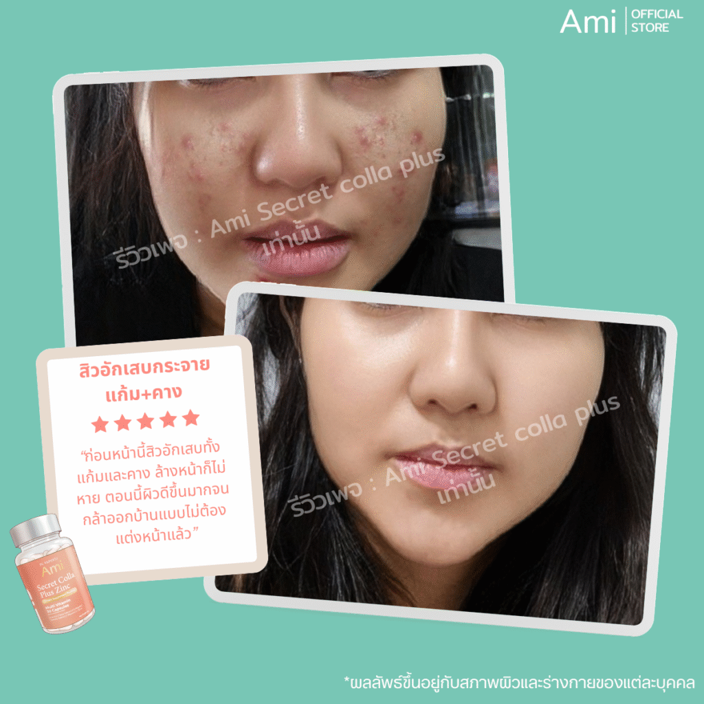 Ami Colla Zinc ของแท้ อาหารเสริมเพื่อผิวสวย ลดสิว รอยสิว บำรุงผิวใสสุขภาพดี