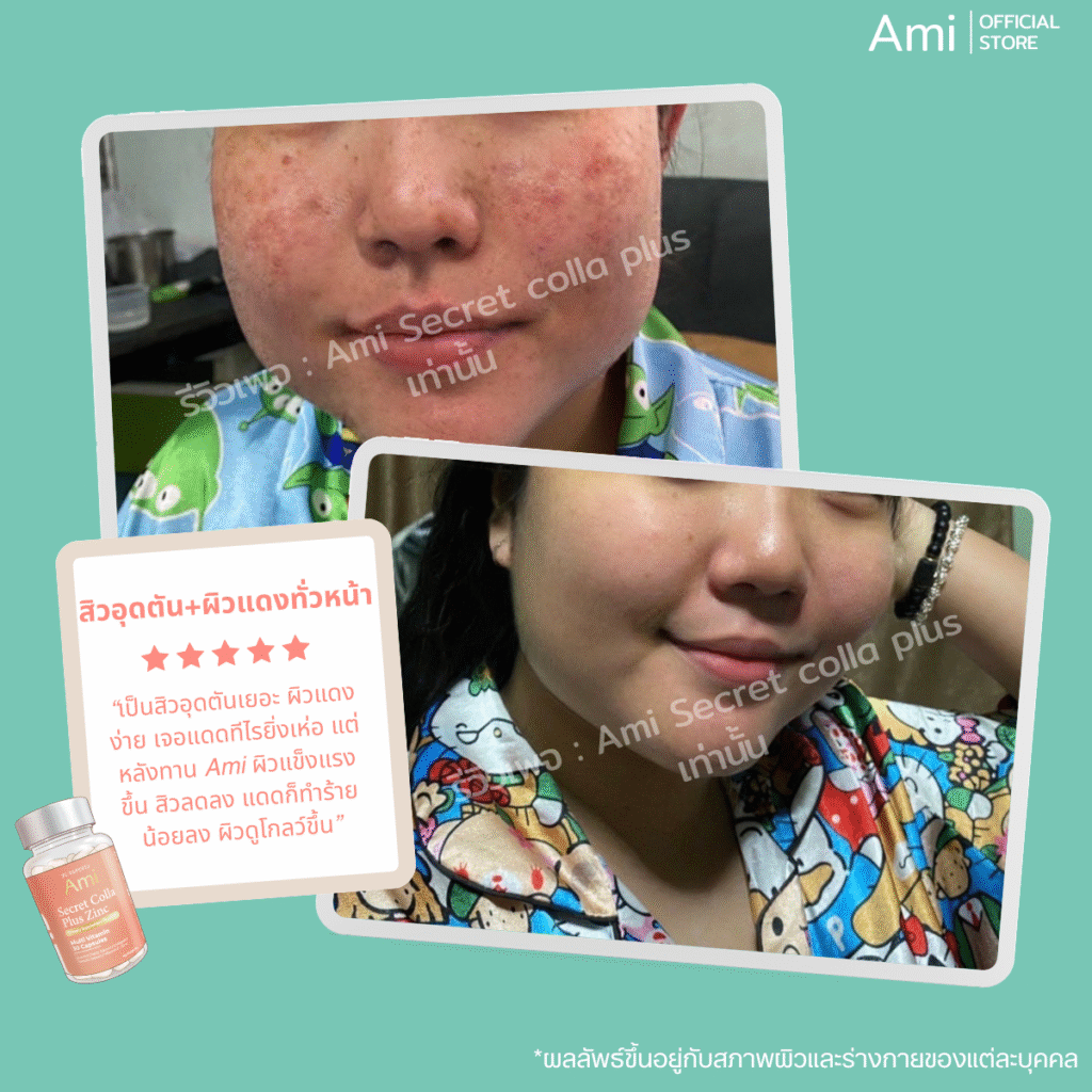 Ami Colla Zinc ผิวใสสุขภาพดี อาหารเสริมเพื่อผิวสวย ลดสิว รอยสิว บำรุงผิวใสสุขภาพดี