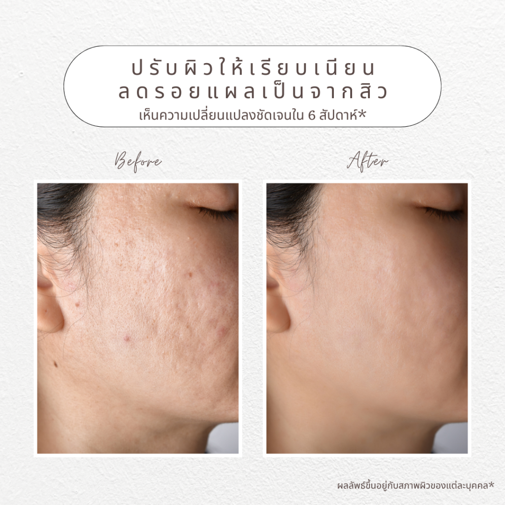 before after